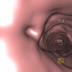 Wegener's granulomatosis of trachea, virtual endoscopy: CT - Computed tomography